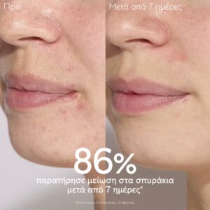4_vinopure_serum_beforeafter_caudalie_el