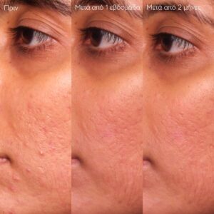 6_vinopure_serum_beforeafter2_caudalie_el