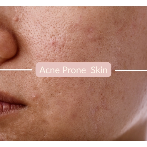 Acne prone skin