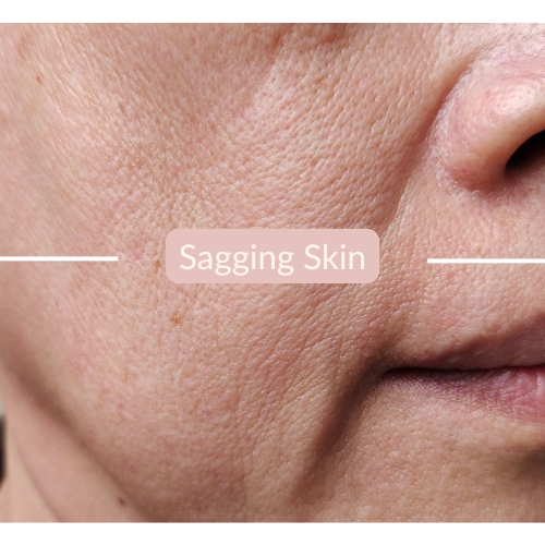 Sagging skin